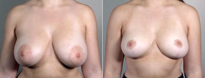 Breast Reduction Case 546 Before & After View #1 | Paramus, New Jersey | Parker Center for Plastic Surgery