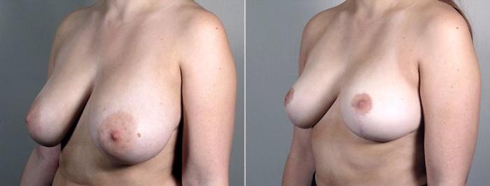 Breast Reduction Case 546 Before & After View #2 | Paramus, New Jersey | Parker Center for Plastic Surgery
