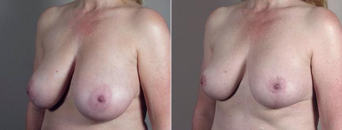 Breast Reduction Case 547 Before & After View #2 | Paramus, New Jersey | Parker Center for Plastic Surgery