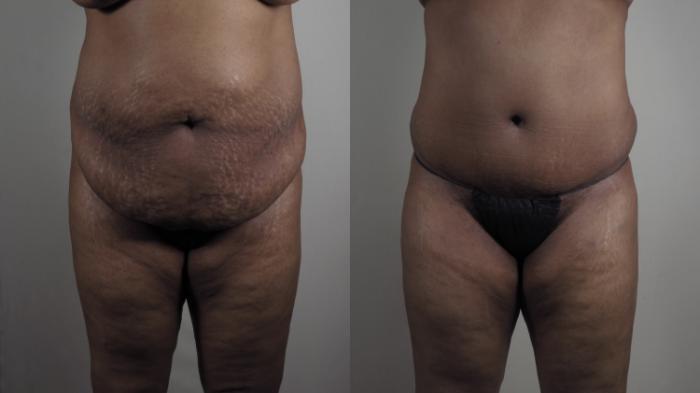 Breast Reduction Case 980 Before & After Front Body  | Paramus, New Jersey | Parker Center for Plastic Surgery