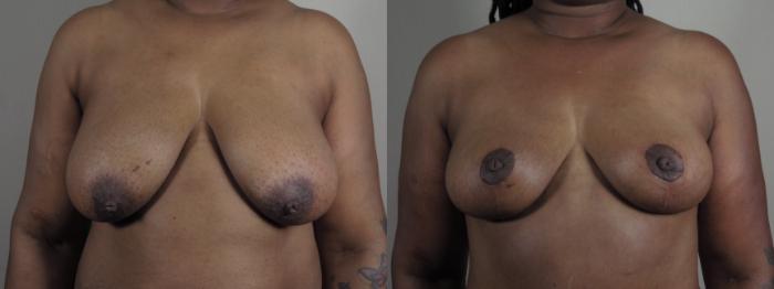Breast Reduction Case 980 Before & After Front | Paramus, New Jersey | Parker Center for Plastic Surgery