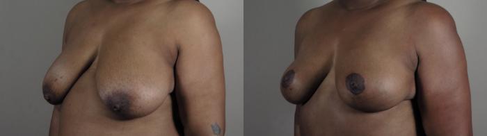 Breast Reduction Case 980 Before & After Right Oblique | Paramus, New Jersey | Parker Center for Plastic Surgery