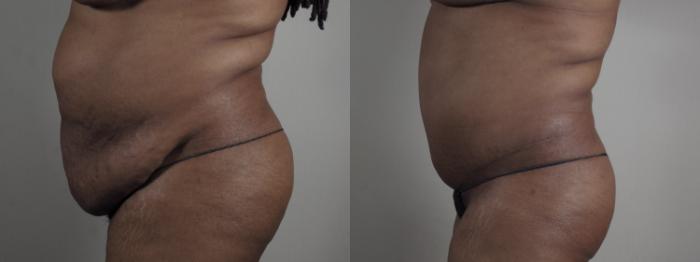 Breast Reduction Case 980 Before & After Right view Body  | Paramus, New Jersey | Parker Center for Plastic Surgery