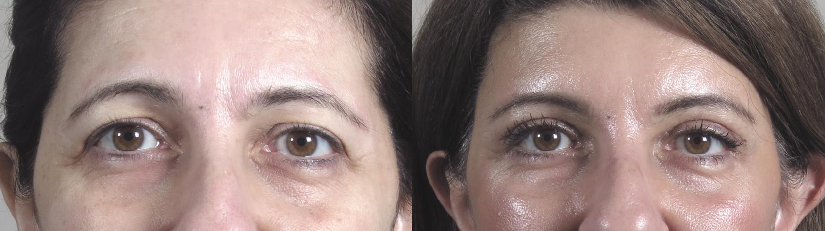 Brow Lift Case 1093 Before & After Front | Paramus, New Jersey | Parker Center for Plastic Surgery