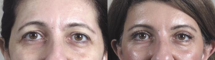 Brow Lift Case 1093 Before & After Front | Paramus, New Jersey | Parker Center for Plastic Surgery