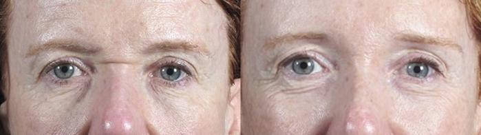 Brow Lift Case 115 Before & After View #1 | Paramus, New Jersey | Parker Center for Plastic Surgery