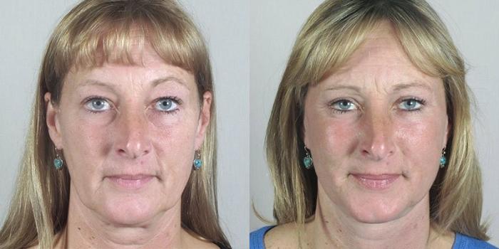 Brow Lift Case 1176 Before & After View 3 | Paramus, New Jersey | Parker Center for Plastic Surgery