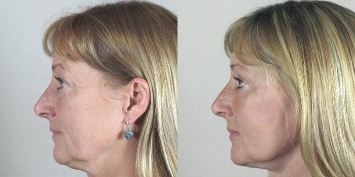 Brow Lift Case 1176 Before & After View 4  | Paramus, New Jersey | Parker Center for Plastic Surgery