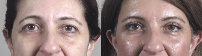 Brow Lift Case 1442 Before & After Front | Paramus, New Jersey | Parker Center for Plastic Surgery