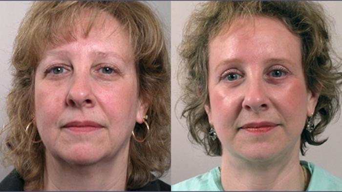 Facelift Case 2 Before & After View #1 | Paramus, New Jersey | Parker Center for Plastic Surgery