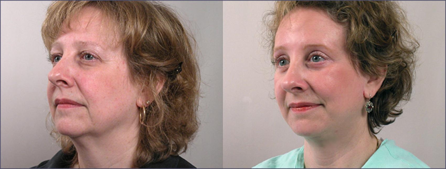Brow Lift Case 2 Before & After View #2 | Paramus, New Jersey | Parker Center for Plastic Surgery