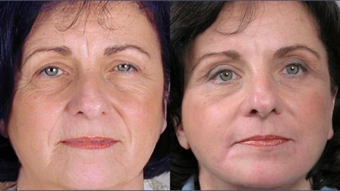 Facelift Case 3 Before & After View #1 | Paramus, New Jersey | Parker Center for Plastic Surgery