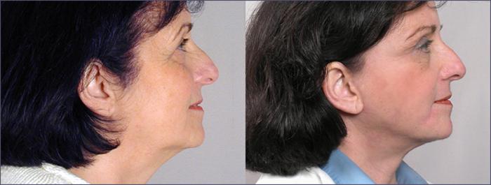 Facelift Case 3 Before & After View #2 | Paramus, New Jersey | Parker Center for Plastic Surgery