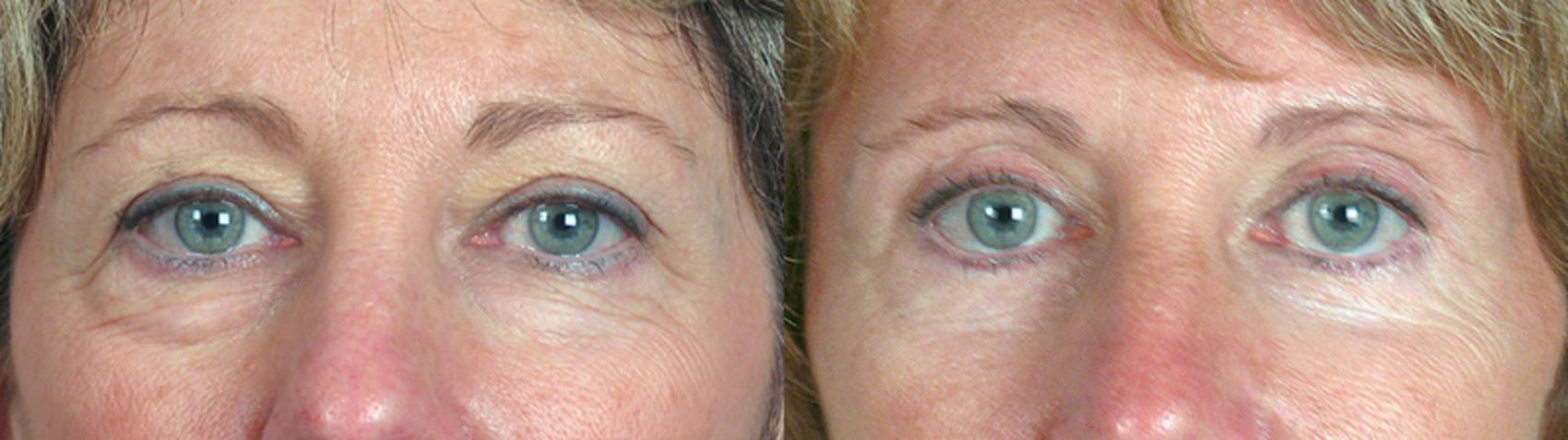 Brow Lift Case 68 Before & After View #1 | Paramus, New Jersey | Parker Center for Plastic Surgery