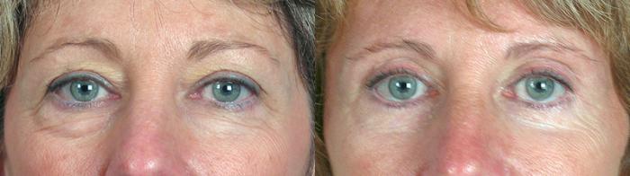 Brow Lift Case 68 Before & After View #1 | Paramus, New Jersey | Parker Center for Plastic Surgery