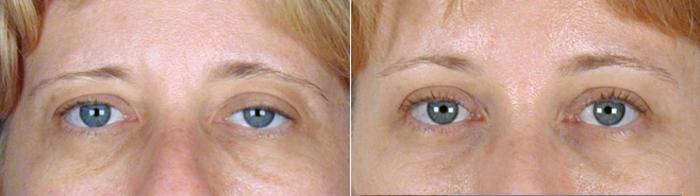 Brow Lift Case 872 Before & After View #4 | Paramus, New Jersey | Parker Center for Plastic Surgery