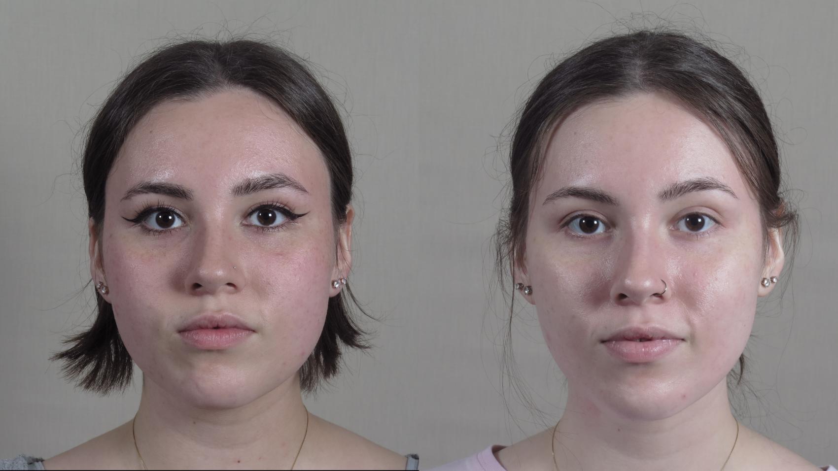 Buccal Fat Excision Case 1280 Before & After Front | Paramus, New Jersey | Parker Center for Plastic Surgery