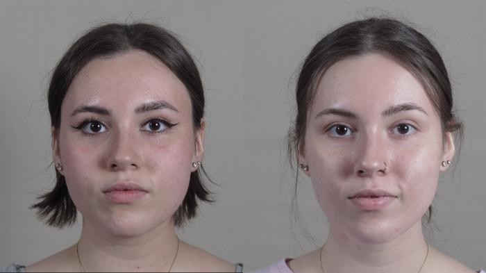 Buccal Fat Excision Case 1280 Before & After Front | Paramus, New Jersey | Parker Center for Plastic Surgery
