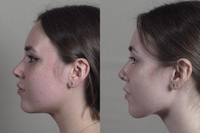Buccal Fat Excision Case 1280 Before & After Left Side | Paramus, New Jersey | Parker Center for Plastic Surgery