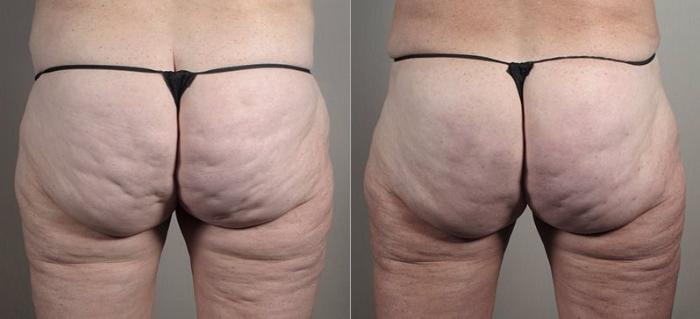 Cellfina Case 840 Before & After View #1 | Paramus, New Jersey | Parker Center for Plastic Surgery