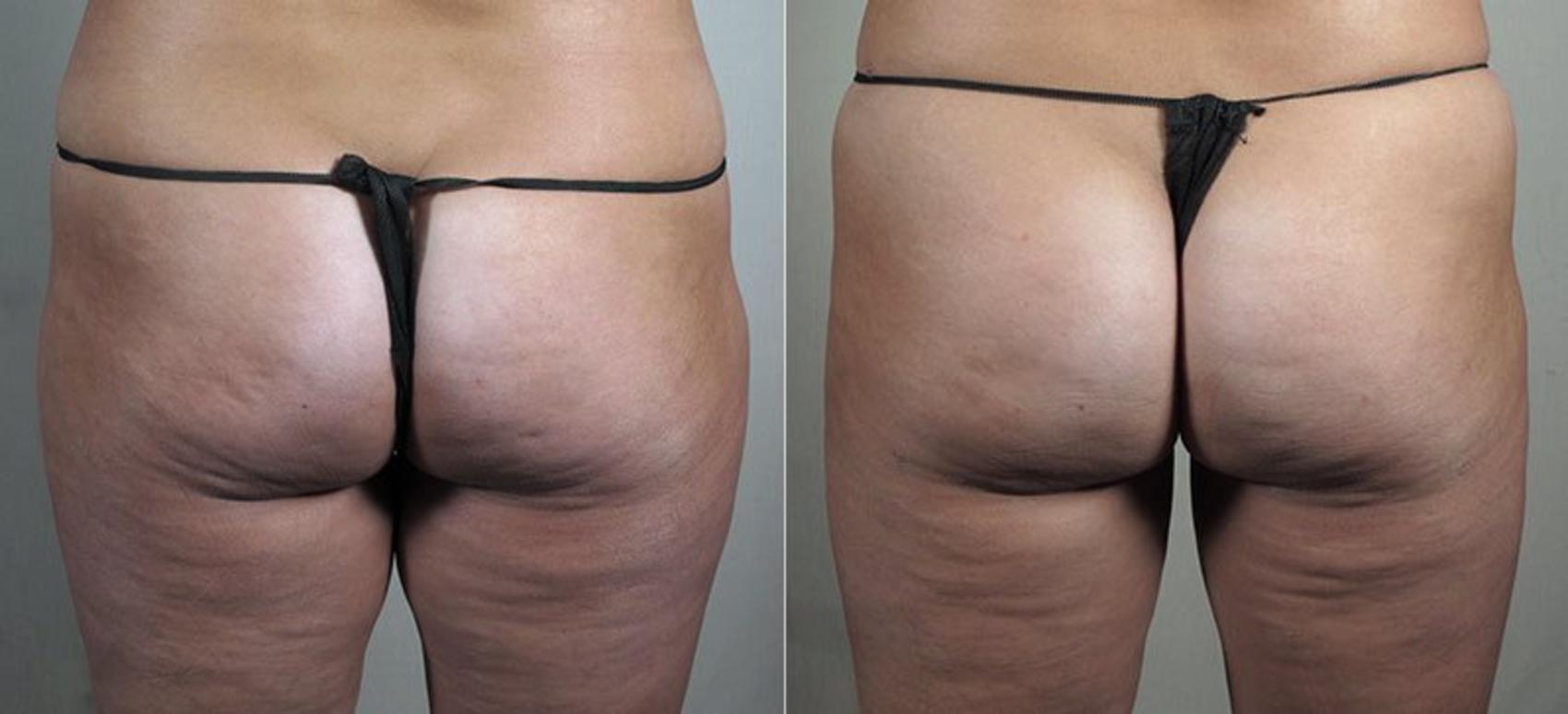 Cellfina Case 841 Before & After View #1 | Paramus, New Jersey | Parker Center for Plastic Surgery