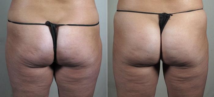 Cellfina Case 841 Before & After View #1 | Paramus, New Jersey | Parker Center for Plastic Surgery