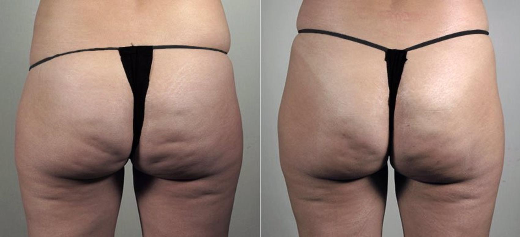 Cellfina Case 842 Before & After View #1 | Paramus, New Jersey | Parker Center for Plastic Surgery