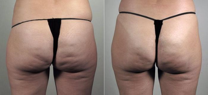 Cellfina Case 842 Before & After View #1 | Paramus, New Jersey | Parker Center for Plastic Surgery