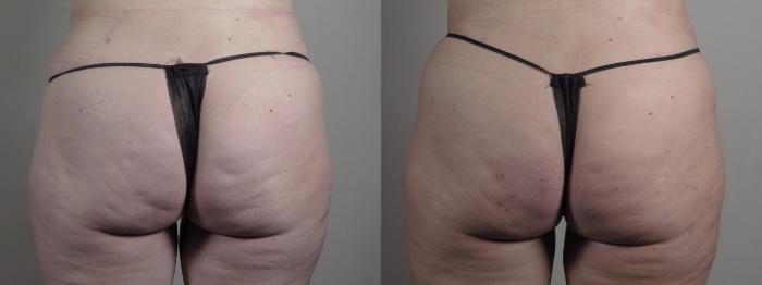Cellfina Case 977 Before & After Back | Paramus, New Jersey | Parker Center for Plastic Surgery