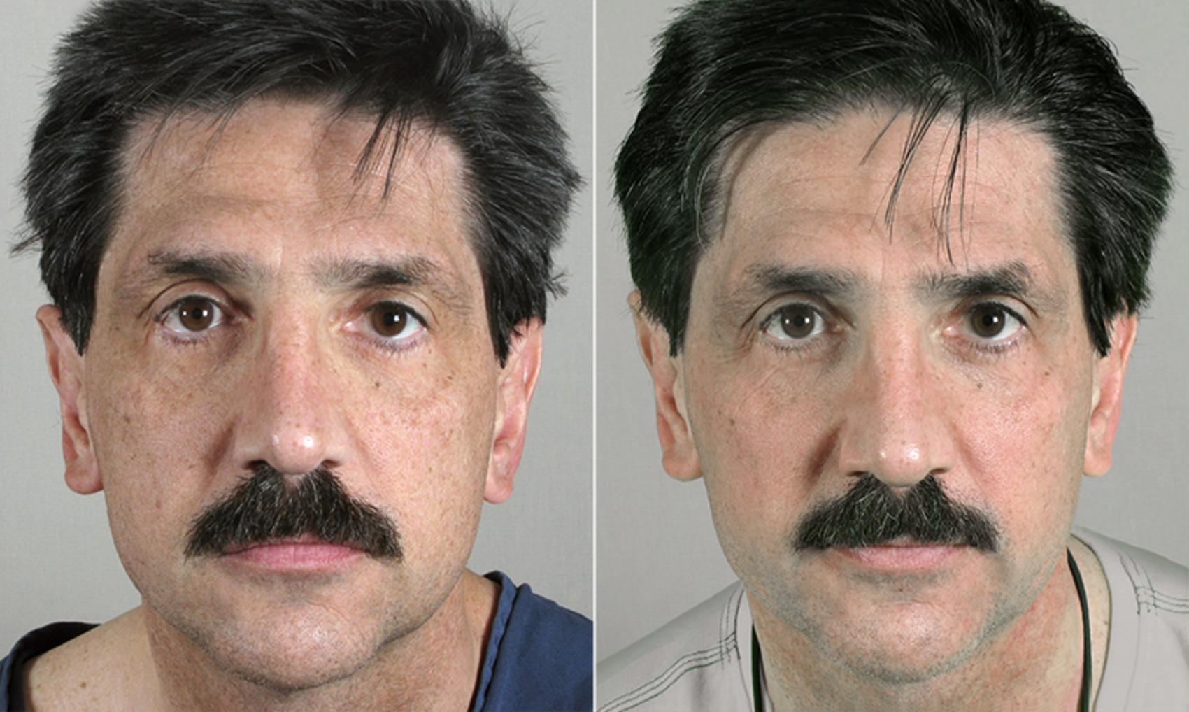 Chemical Peels Case 281 Before & After View #1 | Paramus, New Jersey | Parker Center for Plastic Surgery