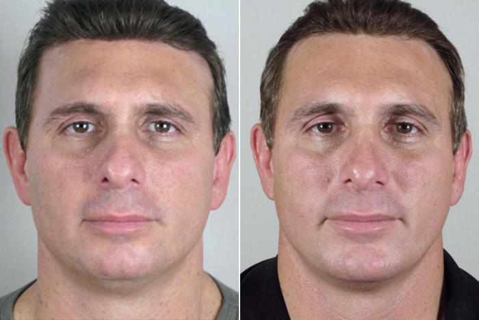 Rhinoplasty Case 116 Before & After View #1 | Paramus, New Jersey | Parker Center for Plastic Surgery