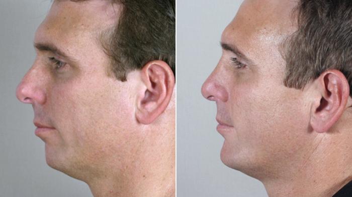 Chin Implant Case 116 Before & After View #2 | Paramus, New Jersey | Parker Center for Plastic Surgery