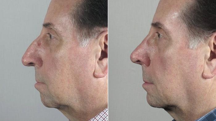 Chin Implant Case 184 Before & After View #1 | Paramus, New Jersey | Parker Center for Plastic Surgery