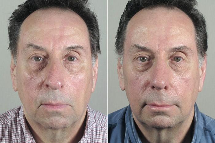 Chin Implant Case 184 Before & After View #2 | Paramus, New Jersey | Parker Center for Plastic Surgery