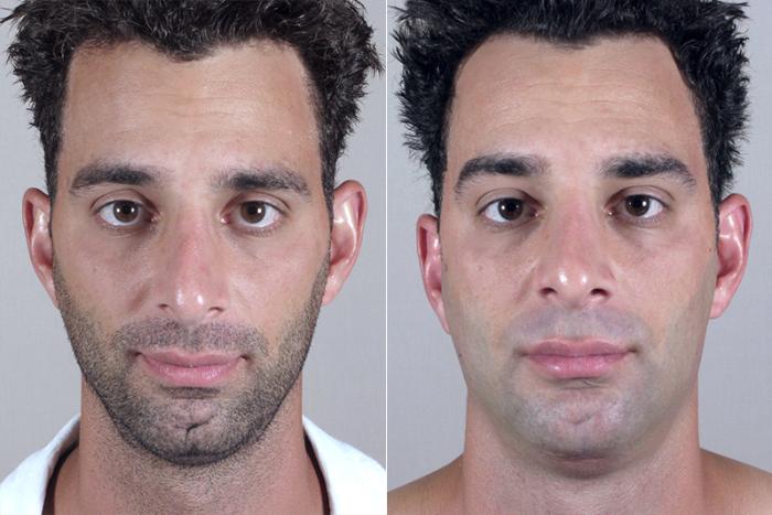 Chin Implant Case 252 Before & After View #1 | Paramus, New Jersey | Parker Center for Plastic Surgery