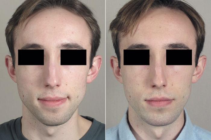 Chin Implant Case 256 Before & After View #1 | Paramus, New Jersey | Parker Center for Plastic Surgery