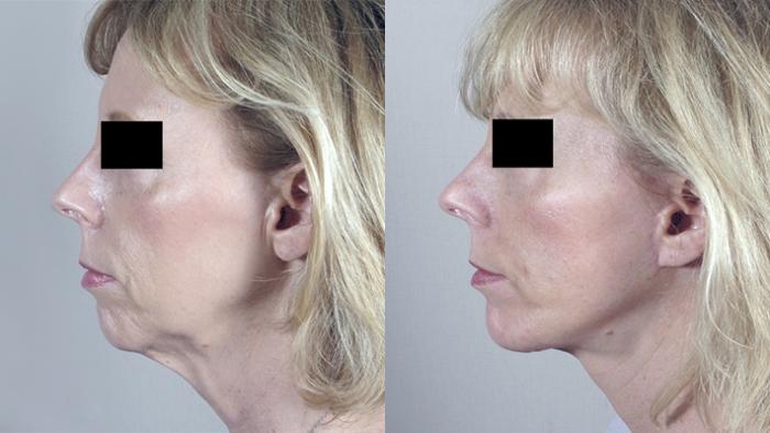 Facelift Case 10 Before & After View #1 | Paramus, New Jersey | Parker Center for Plastic Surgery