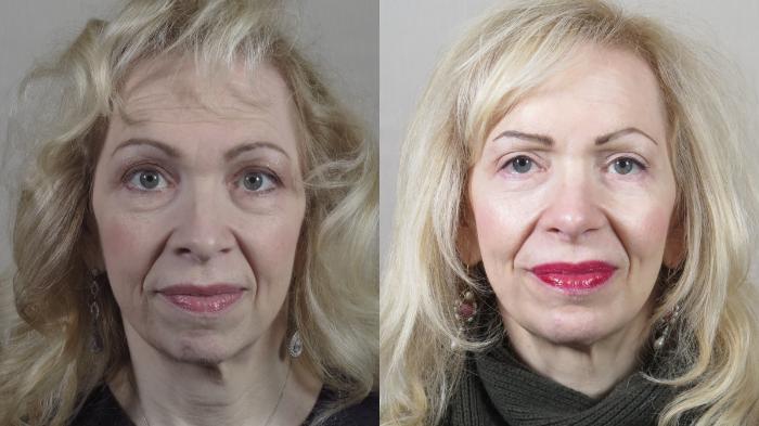 Chin Implants Case 1534 Before & After Front | Paramus, New Jersey | Parker Center for Plastic Surgery