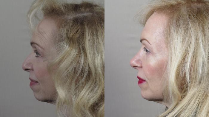 Chin Implants Case 1534 Before & After Left Side | Paramus, New Jersey | Parker Center for Plastic Surgery