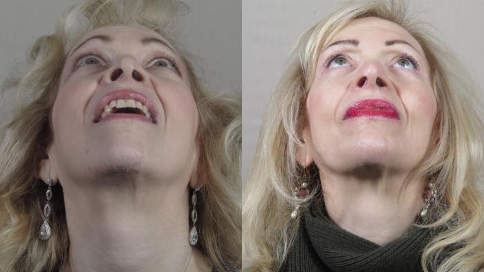 Chin Implants Case 1534 Before & After worn's | Paramus, New Jersey | Parker Center for Plastic Surgery