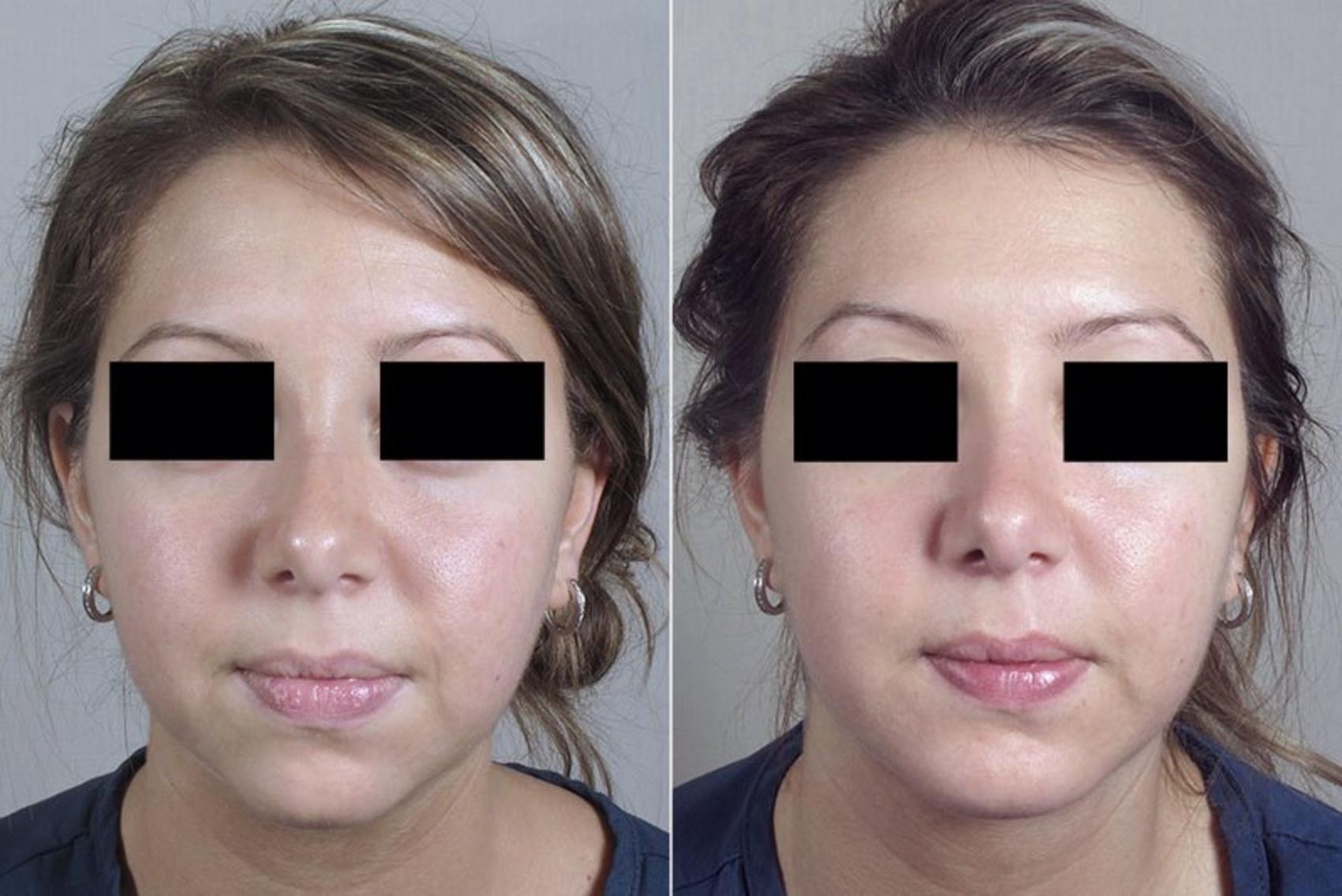 Chin Implants Before and After Pictures Case 255 | Paramus, New Jersey ...