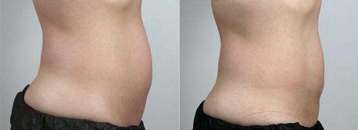 CoolSculpting® Case 835 Before & After View #2 | Paramus, New Jersey | Parker Center for Plastic Surgery