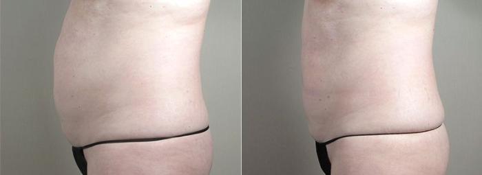 CoolSculpting® Case 836 Before & After View #2 | Paramus, New Jersey | Parker Center for Plastic Surgery