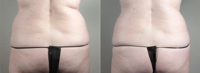CoolSculpting® Case 836 Before & After View #3 | Paramus, New Jersey | Parker Center for Plastic Surgery