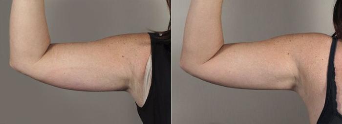 CoolSculpting® Case 838 Before & After View #2 | Paramus, New Jersey | Parker Center for Plastic Surgery