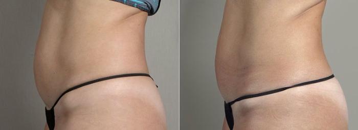 CoolSculpting® Case 839 Before & After View #2 | Paramus, New Jersey | Parker Center for Plastic Surgery