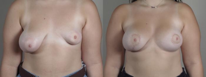 Correction of Tubular Breasts Case 1219 Before & After View #1  | Paramus, New Jersey | Parker Center for Plastic Surgery