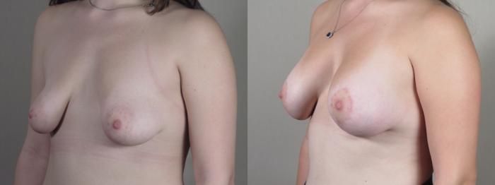 Correction of Tubular Breasts Case 1514 Before & After Left Oblique | Paramus, New Jersey | Parker Center for Plastic Surgery