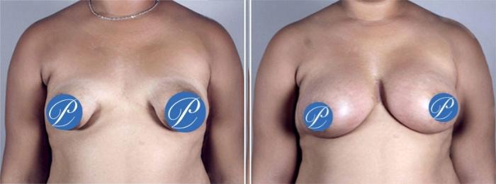 Correction of Tubular Breasts Case 904 Before & After View #5 | Paramus, New Jersey | Parker Center for Plastic Surgery
