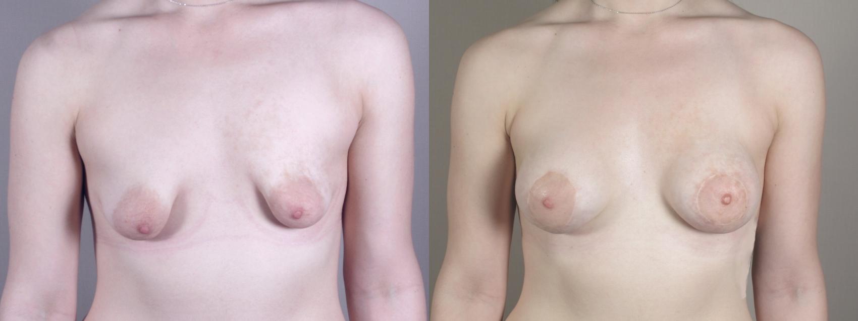 Correction of Tubular Breasts Case 971 Before & After Front | Paramus, New Jersey | Parker Center for Plastic Surgery